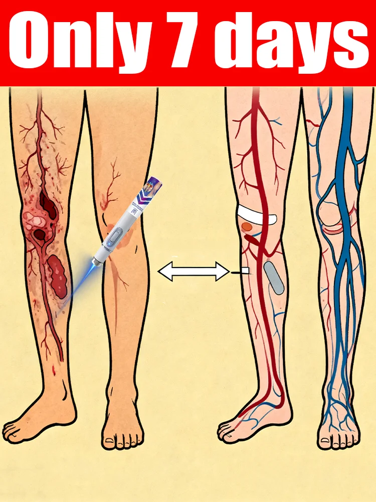 

Lᴀsᴇʀ ɪɴsᴛʀᴜᴍᴇɴᴛ ғᴏʀ ᴠᴀʀɪᴄᴏsᴇ ᴠᴇɪɴ ᴄᴏʀʀᴇᴄᴛɪᴏɴ