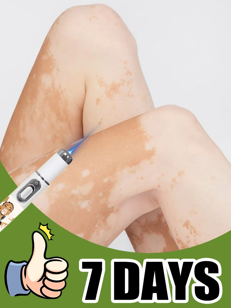 

1nd generation Vitiligo treatment pen, used to treat Vitiligo