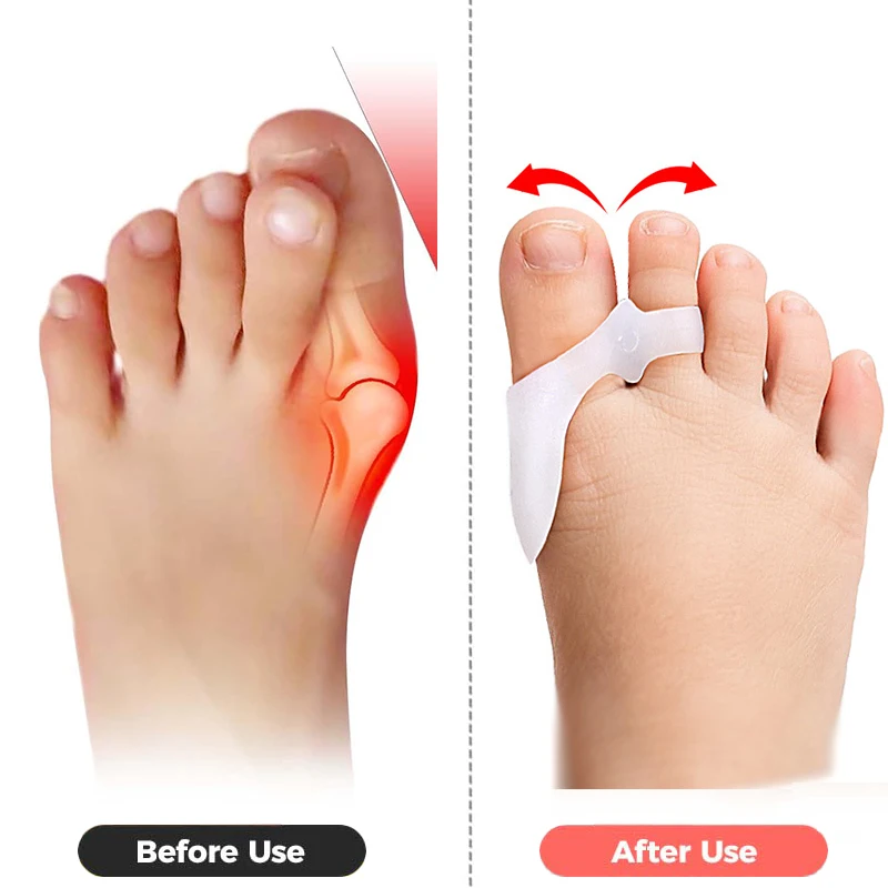 Pexmen 2/4 قطعة فواصل أصابع القدم مصحح الورم للأطفال فواصل أصابع القدم مزيلات مسامير القدم المطرقة لأصابع القدم #2