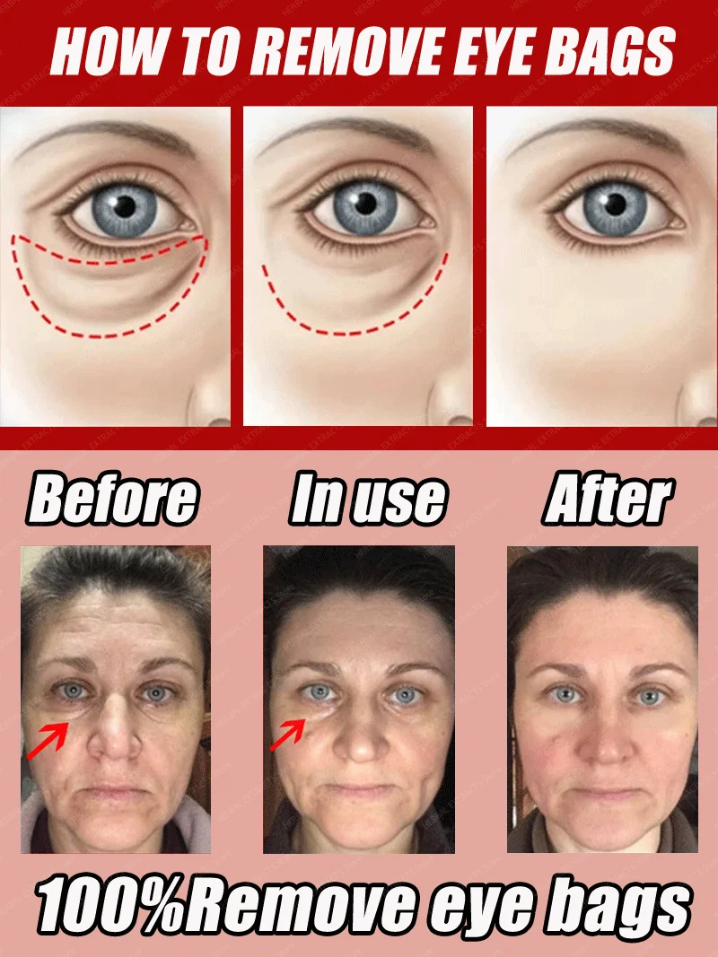Crème pour les yeux au collagène, élimine les poches, Anti-cernes, poches, réduit les rides, hydratant, raffermissant, beauté des yeux, produit de soins de la peau