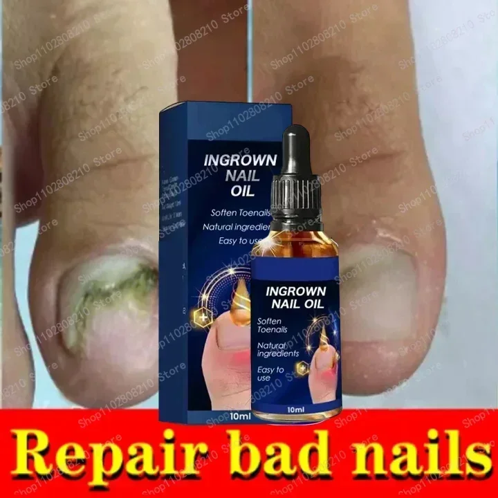 ขายร้อน Fungal NAIL Removal 10ML Fungal NAIL Foot Repair Essence เล็บเชื้อราเจลกําจัด Anti Infection