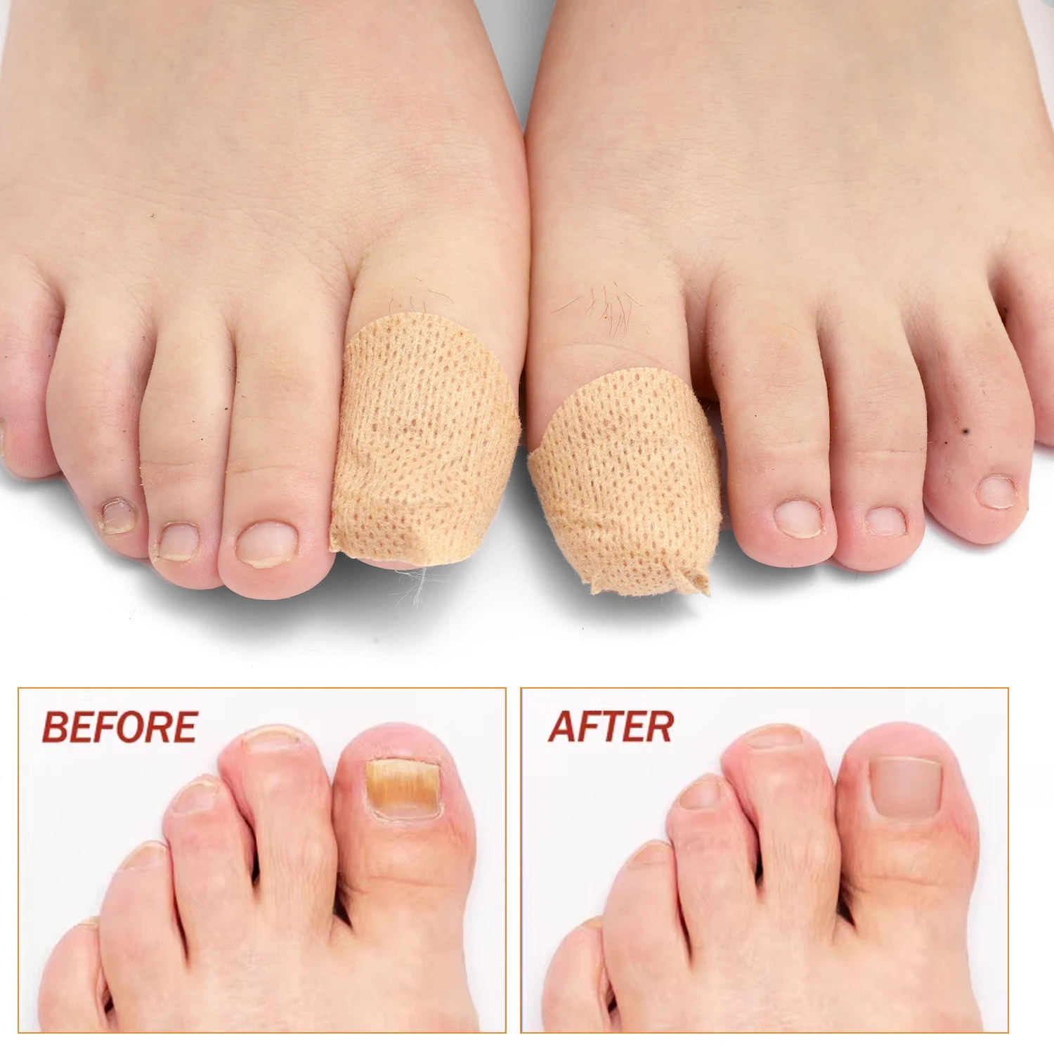 Remendo de fungo de unha à prova d'água, 21/105 peças, adesivo de correção de unhas encravadas, adesivo de cuidados cinza para unhas danificadas, ferramentas de cuidados com os pés