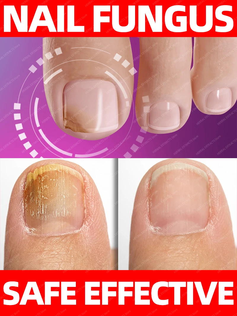 

quick repair of feet nails