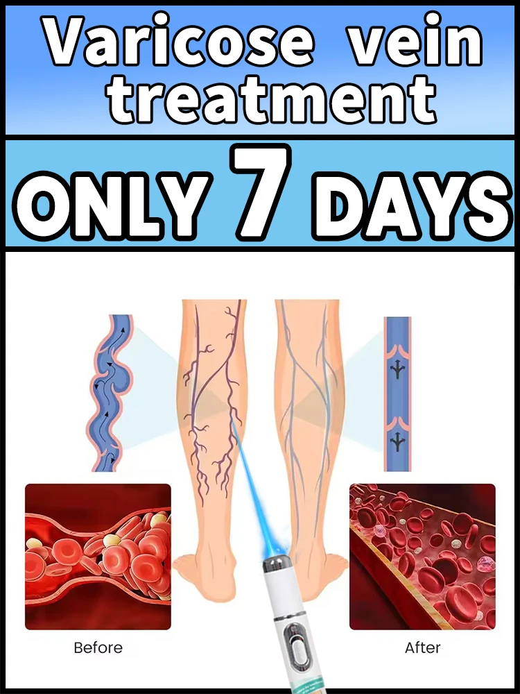 

Wireless blue light leg care pen: Gentle and safe at-home treatment