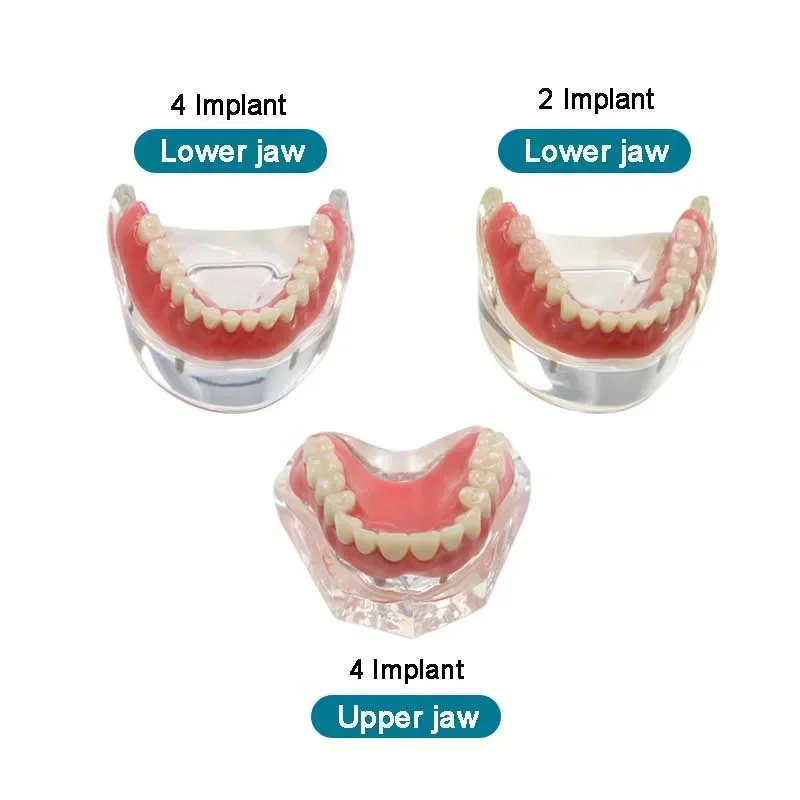 

Dental Implant Restoration Teeth Model with Implants Upper/Lower Dental Implant Demonstration Teeth Model