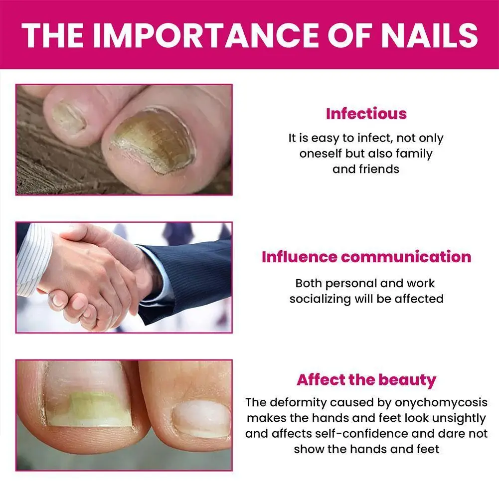 Extra Strong Nail Fungus Treatment Serum Essence Oil Infection Essence Feet Fu Nails Anti Toe Gel Care Cream Repair Removal B6W1