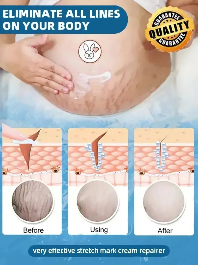 Krim penghilang Stretch mark merah putih, Gel perawatan kulit anti melahirkan