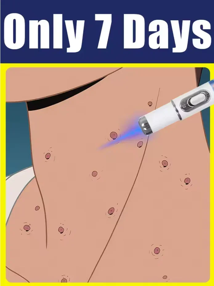 blauw licht pen los wratten op, hete verkoop wrattenverzorgingstools