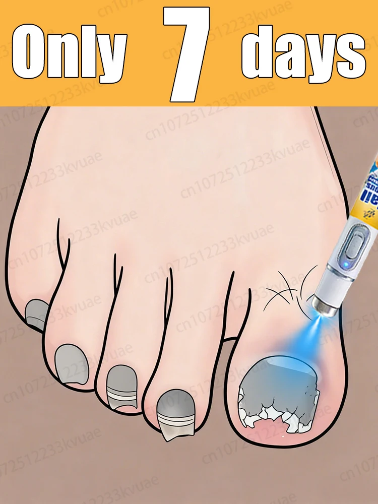 

Say goodbye to onychomycosis, no recurrence, no damage to nails.