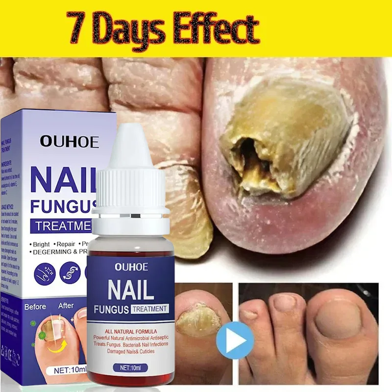 New Repair Nail Fungus Treatments Essence Anti Fungal Nail Treatment Repair Finger Toe Care Nail Fungus Liquid