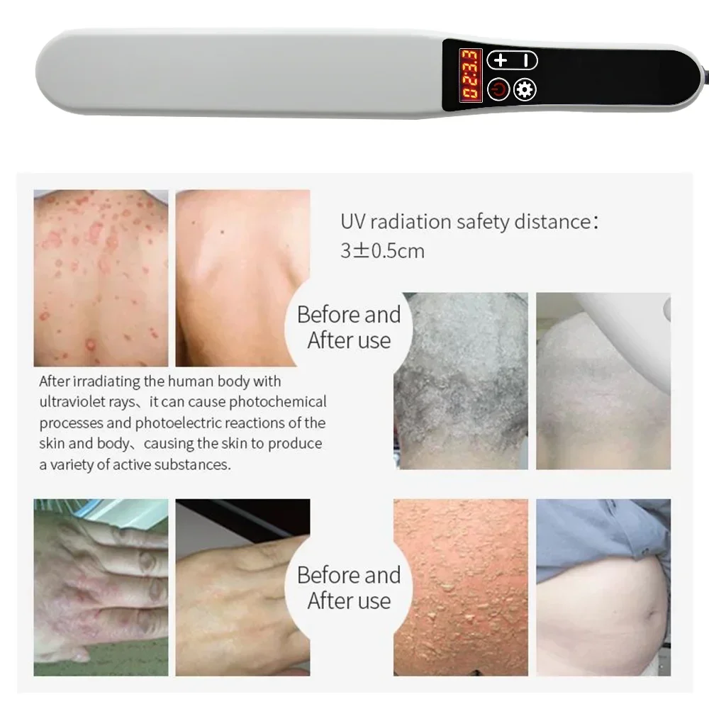 311nm Narrowband UVB Phototherapy Lamp 48cm² Large Coverage Handheld Digital Timer UV Light Home Auxiliary Skin Care for Vitilig - view 2