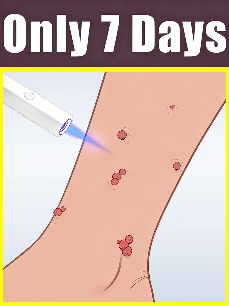 Visible en 7 jours, élimination rapide des verrues, le laser frappe directement la cause racine