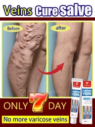 Varicose Vein Repair Hot Selling