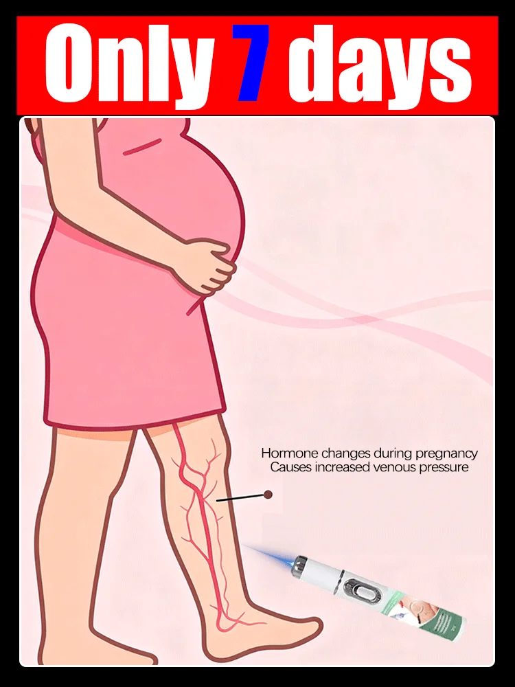 

2nd generation laser venous treatment pen, used to treat varicose veins