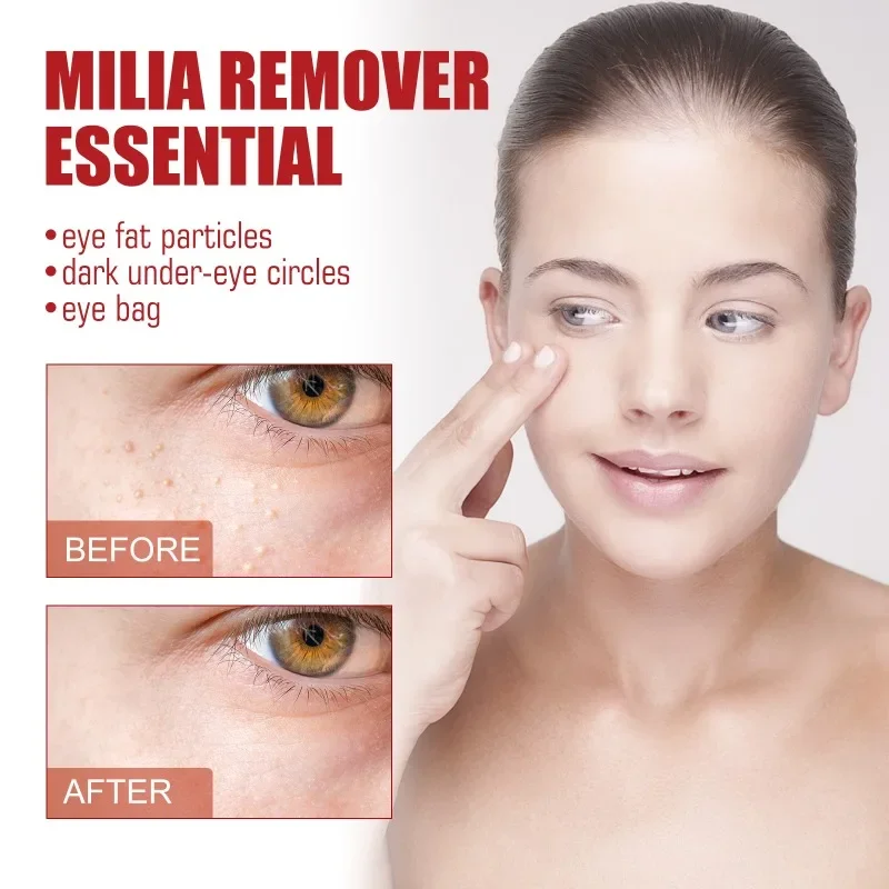 Milia Remover Essential Eye Serum Effective Removes Fat Granules eye Bags Anti-Particles Puffiness Improve Dark Cicle 30ml