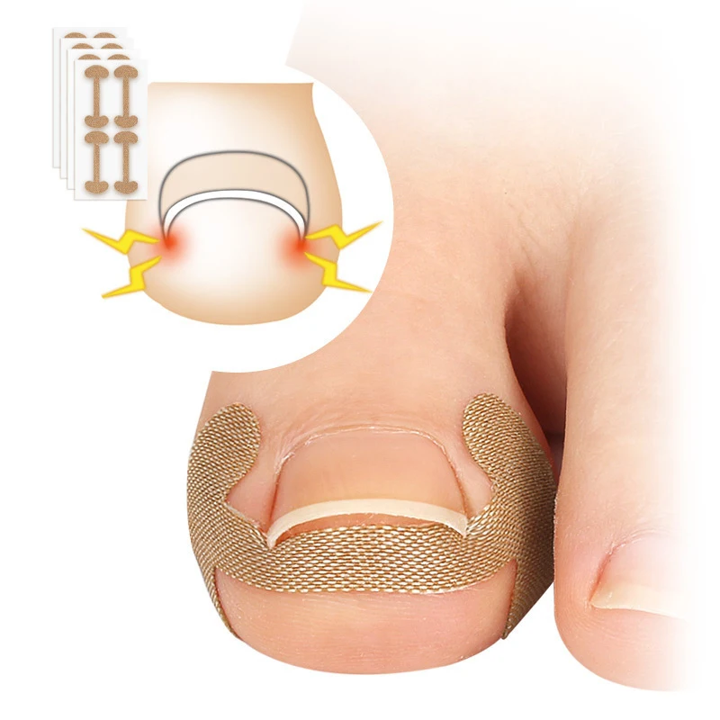 Ingrown Toenail Corrector Patches Nail Correction Stickers for Paronychia Treatment Pedicure Care Tool for Recovering Nails