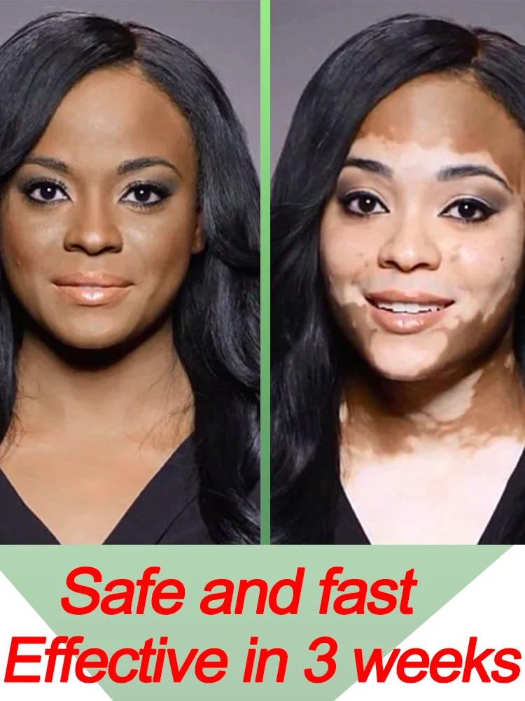 

Vitiligo Treatment Cream Ointment Repair