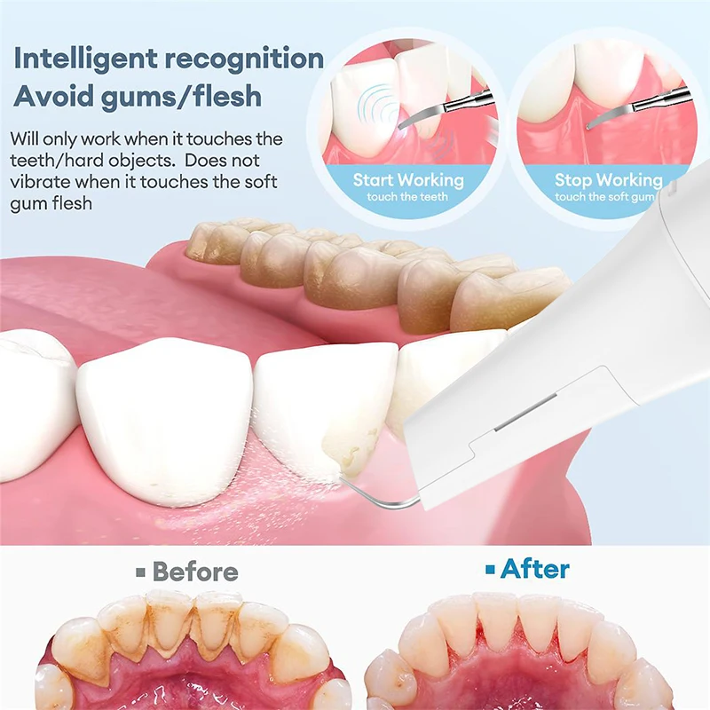 Removedor de cálculo doméstico Visible T13 Pro, limpiador de dientes ultrasónico, aplicación inalámbrica, limpiador de dientes sónico electrónico, escalador Dental