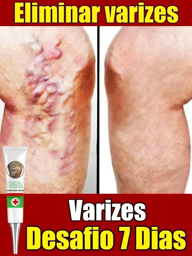 Effective varicose vein soothing cream. Vasculitis, phlebitis, spider leg soothing cream