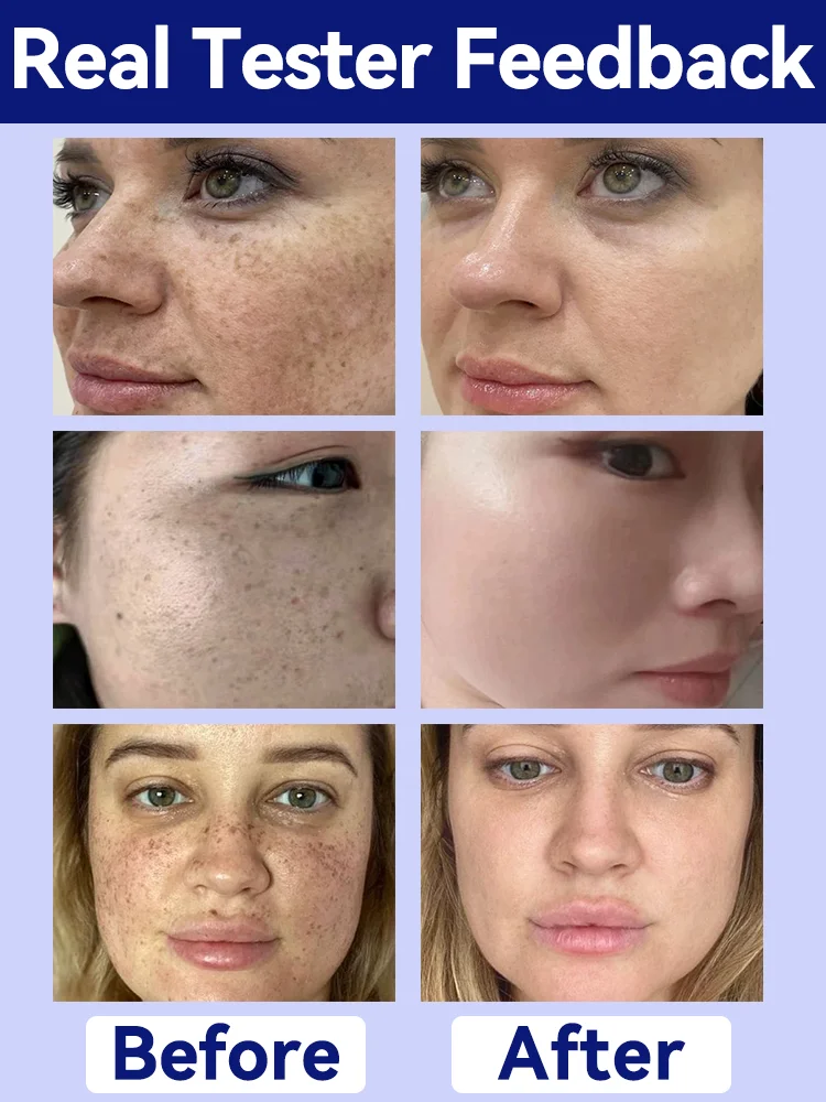 Laser quick repair of facial freckles