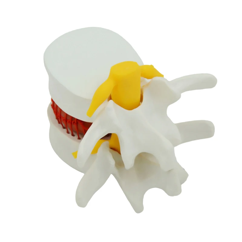 Human Anatomy Skeleton Spine Lumbar Disc Herniation Teaching Model Magnifying Spinal Lesions Medical Teaching Tool