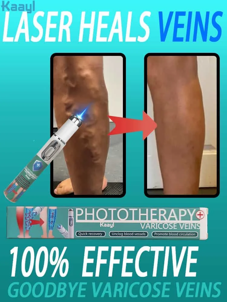 

Laser vein | IVaricose vein laser pointer | for Anyone with Sedentary or Standing