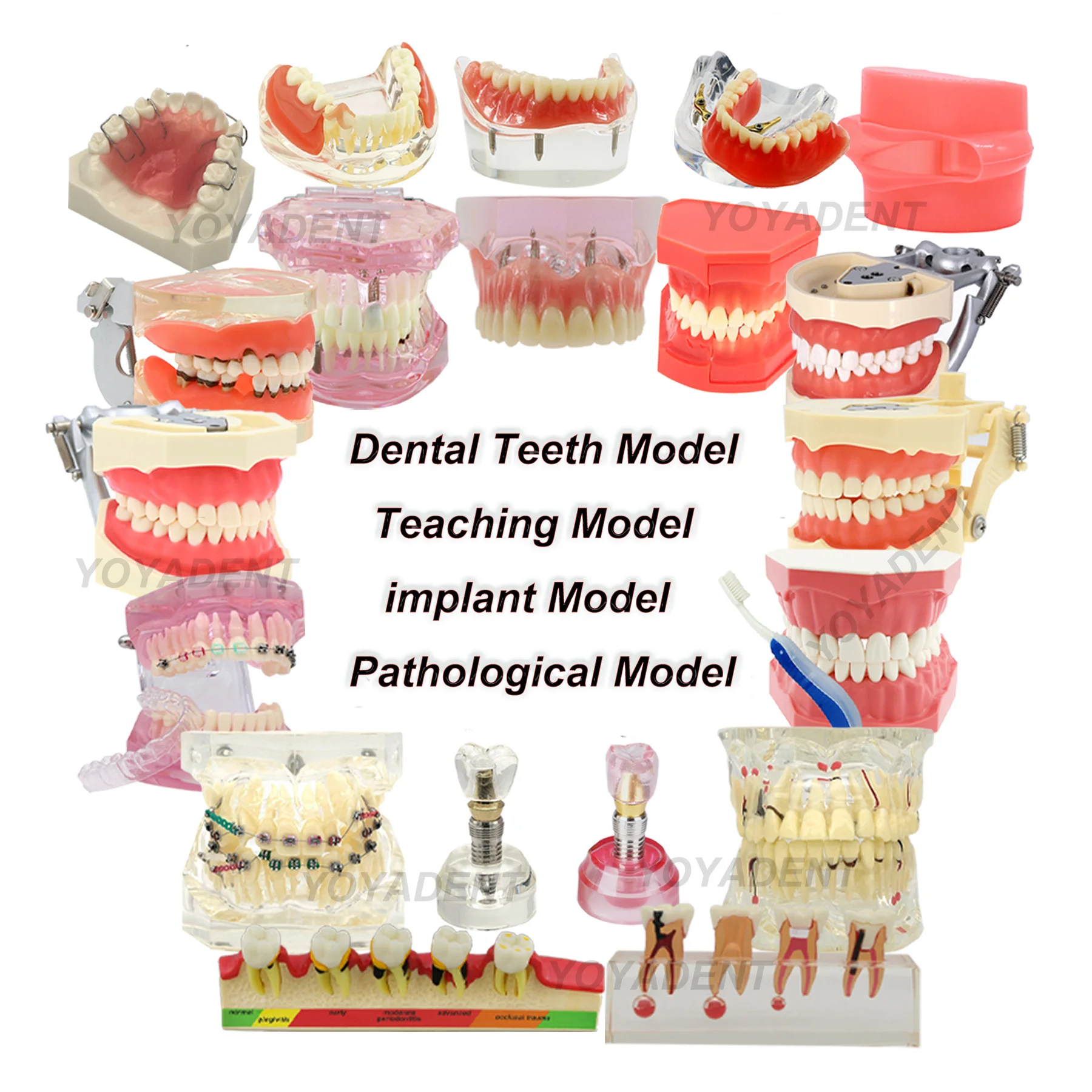 Modelo de implante de dentes dentários, vários tipos, modelos de ensino de odontologia, ortodôntico removível para educação de pacientes, demonstração