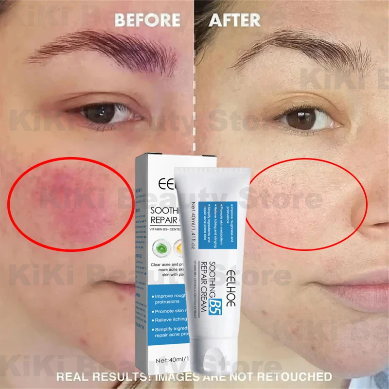 Instant Facial Redness Repair Cream Soothing Red Blood Rosacea Treatment Improve Sensitive Skin Moisturizing Skin Care Products