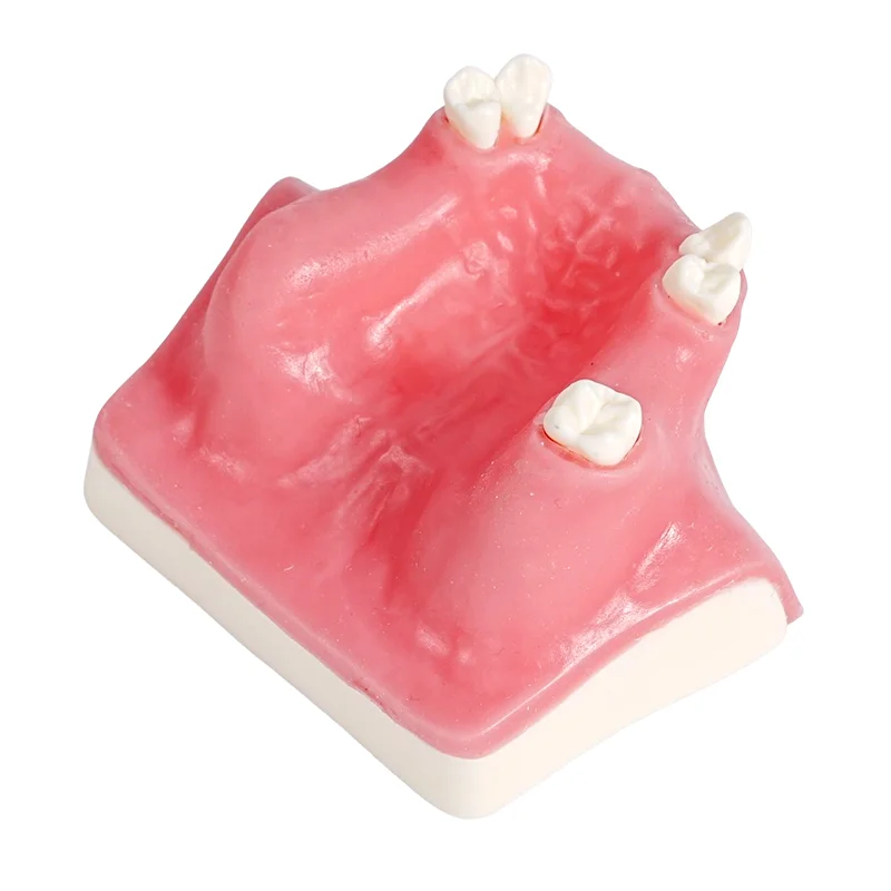 1pc Dental Implant Maxillary Sinus Teeth Model Upper Jaw Sinus Lift Implants Restoration Dentist Student Practice Teaching Model