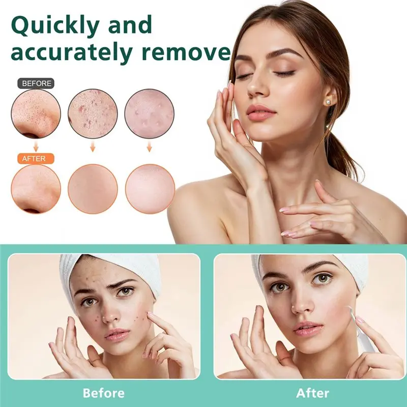 【شعبية】أداة الوجه لأداة الوجه المهنية مزيل الرؤوس السوداء 30 مرة التكبير 1080P HD كاميرا بثرة بوبر