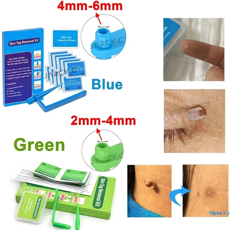 Skin Tag Removal Kit Papilloma Removal Skin Cleansing Band Kit For Remove Skin Berrugas Wart Dots Mole Removal Beauty Appliances