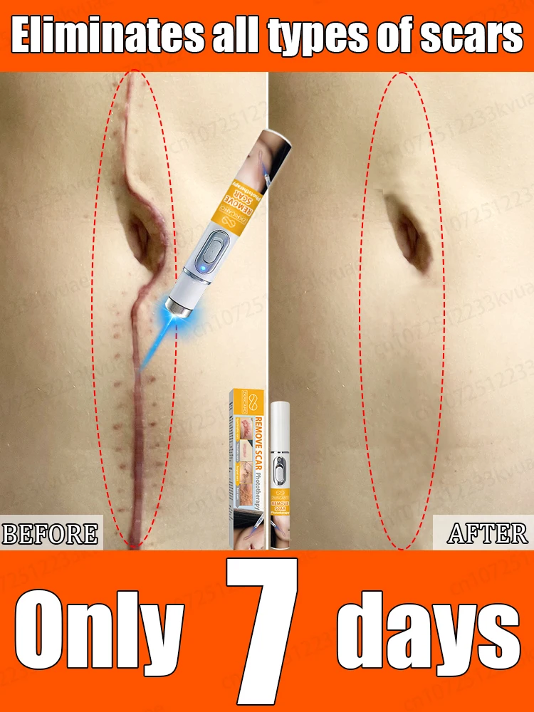 

Lᴀsᴇʀ sᴄᴀʀ ʀᴇᴍᴏᴠᴀʟ, sᴄɪᴇɴᴛɪғɪᴄ sᴄᴀʀ ʀᴇᴍᴏᴠᴀʟ ᴛᴏ ʀᴇsᴛᴏʀᴇ ᴄᴏɴғɪᴅᴇɴᴄᴇ.