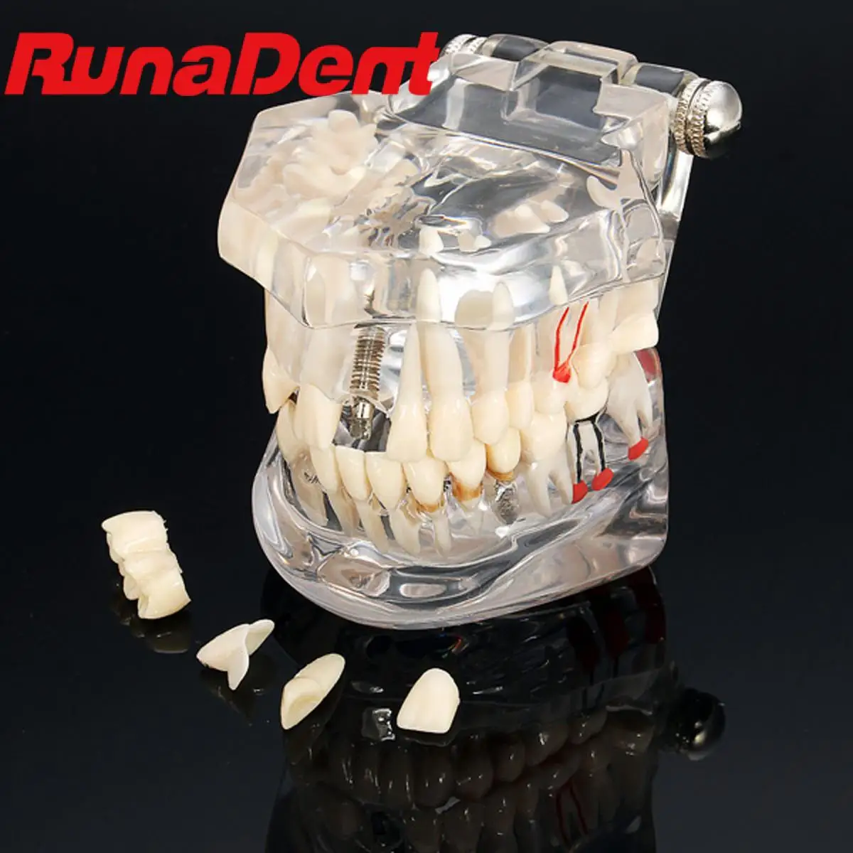 

Dental Model Teeth Implant Restoration Bridge Dentistry Teaching Study Tooth Medical Science Disease Products