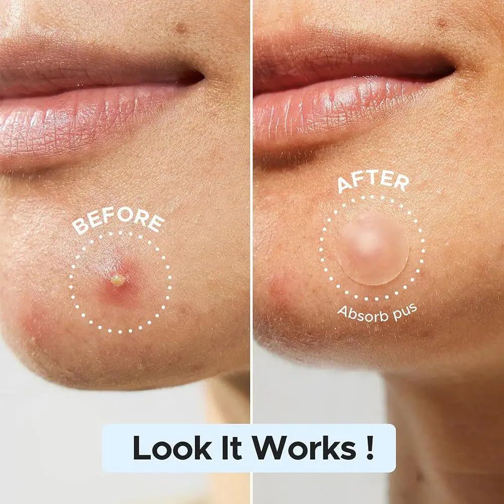 Akne Pickel Patches Unsichtbare Entfernung Pickel Anti-Akne Hydrokolloid Patches Flecken Mark Concealer Wasserdicht Reparatur Aufkleber
