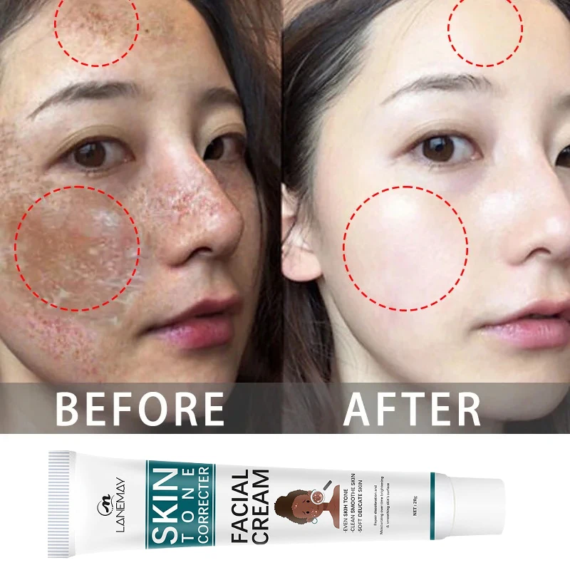 Freckle Removal Cream Face Dark Spot Melasma Remover Lighten Pigmentation Brighten Products Moisturizing Whitening Skin Care