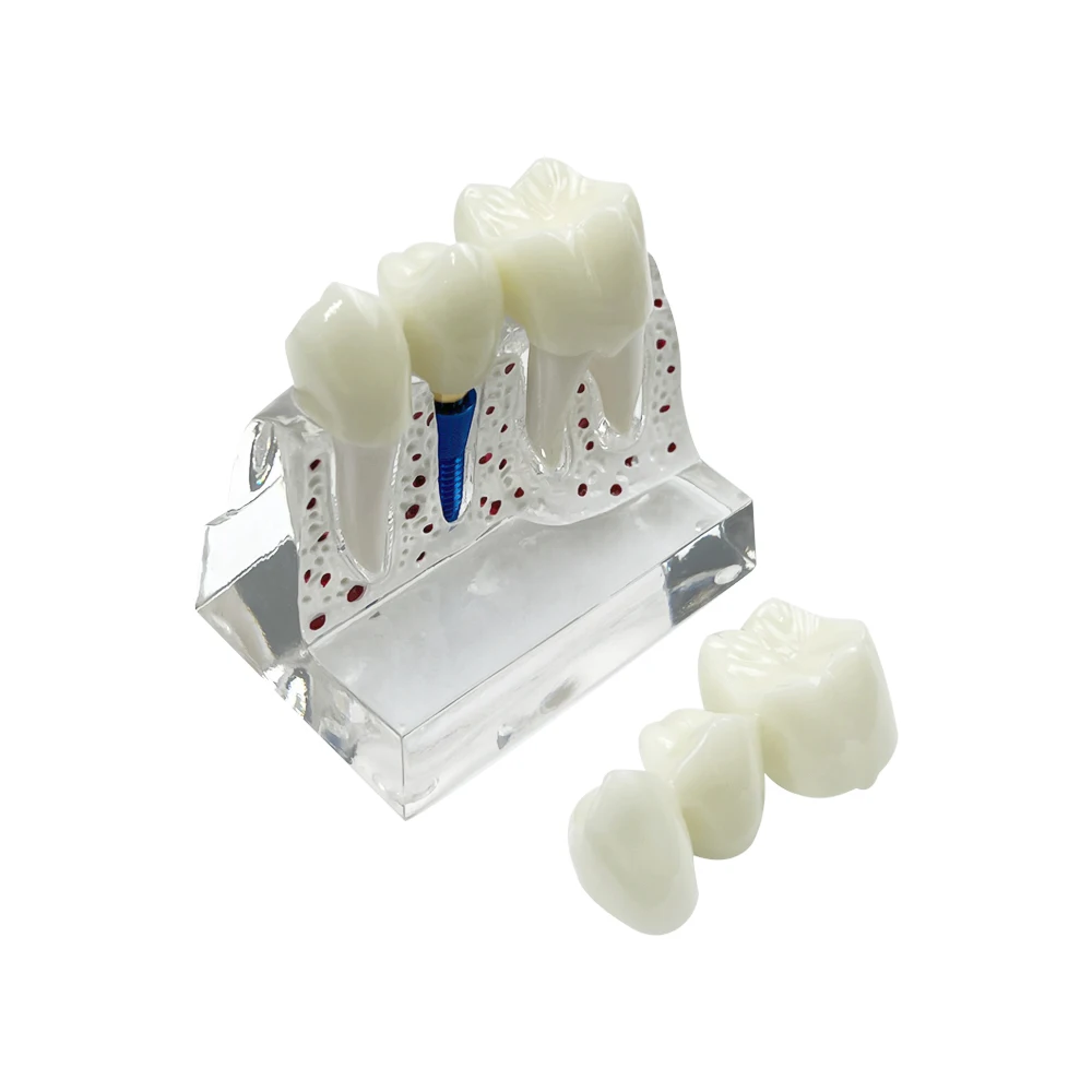 Teeth Model Dental 4 Times Analysis Crown Bridge Removable Teach Demonstration Model Dentist Study teaching clinic Gift