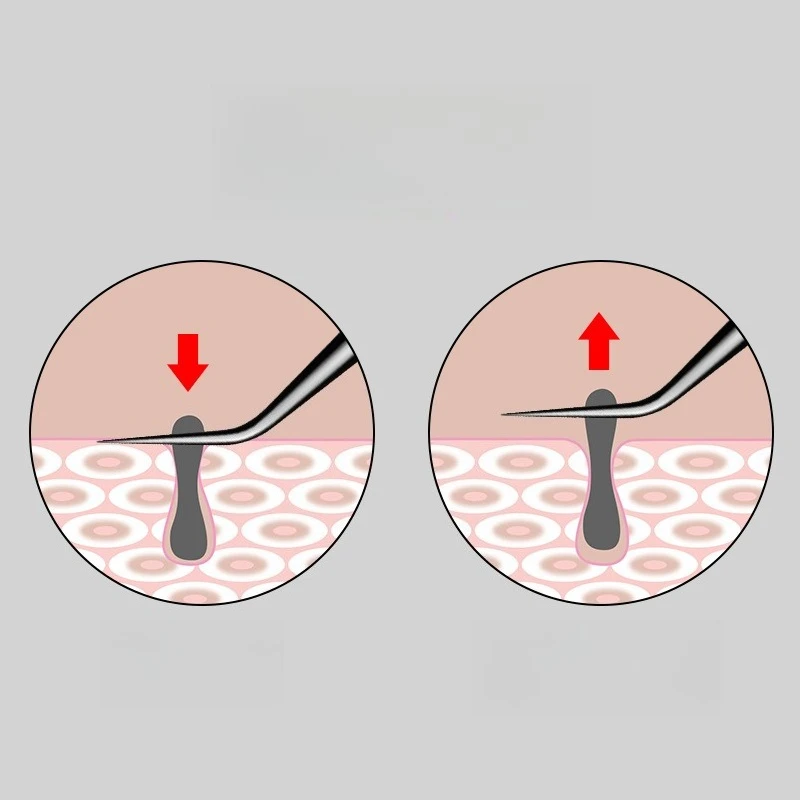 Rvs Acne Verwijdering Naalden Puistje Comedondrukker Gereedschap Dots Cleaner Pore Cleaner Diepe Reiniging Gezicht Huidverzorging Tool