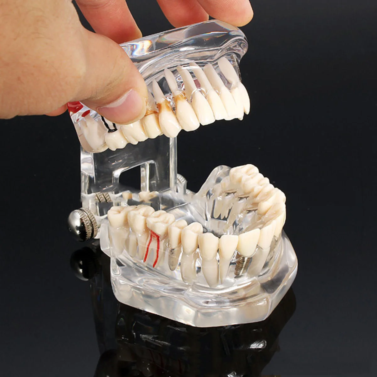 Transparent Disease Teeth Model Dental Implant Teeth Model Dentist Dental Student Learning, Teaching, Research Communication