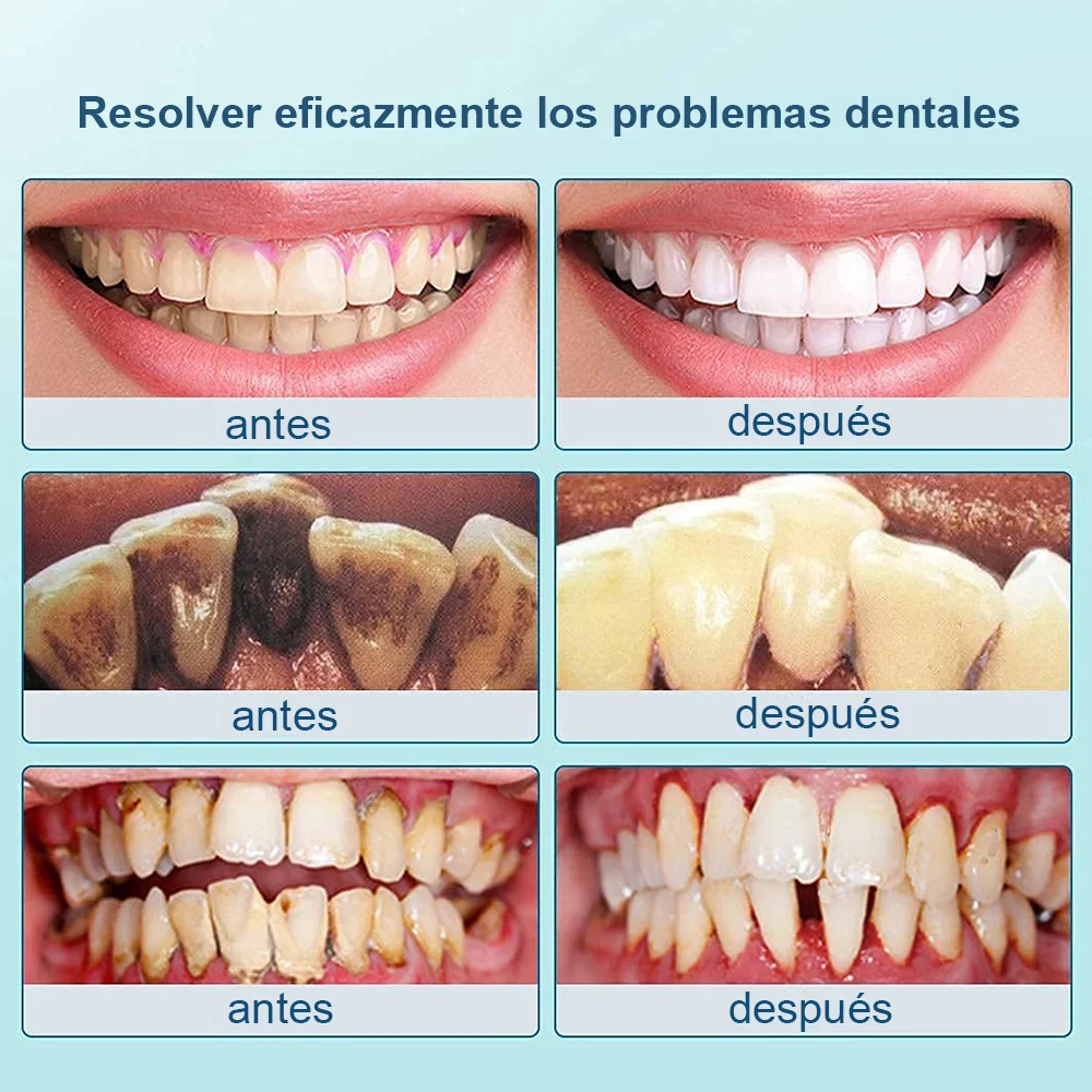 초음파 치과 스케일러 전기 구강 치아 치석 제거기, 치석 플라크 얼룩 클리너, LED 포함 치아 미백 도구