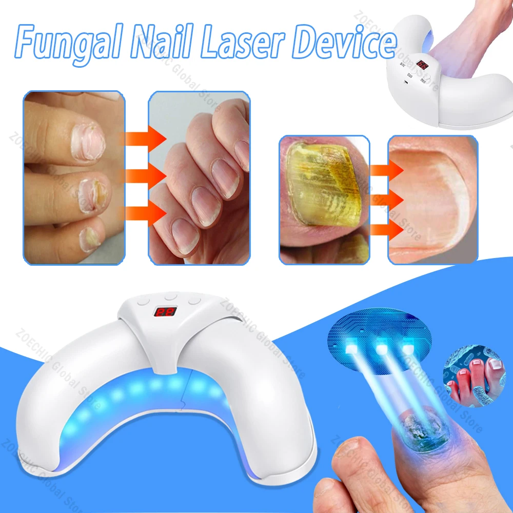 Toenail fungino Nail trattamento Laser riparazione unghie veloci fungo onicomicosi riparazione rimuove il dispositivo fungo del chiodo dell\'unghia