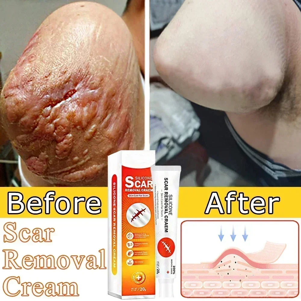 ᴴᴼᵀ Reliable Scar Removal Remove Acne Spots Treatment Stretch Marks Burn Surgical Scar Smoothing Whitening Pigmentation Care