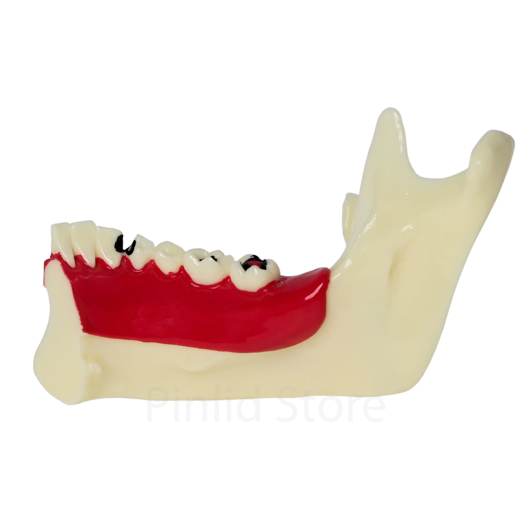 Dental model Endodontic material M4014 Demonstration of adult periodontal disease classification