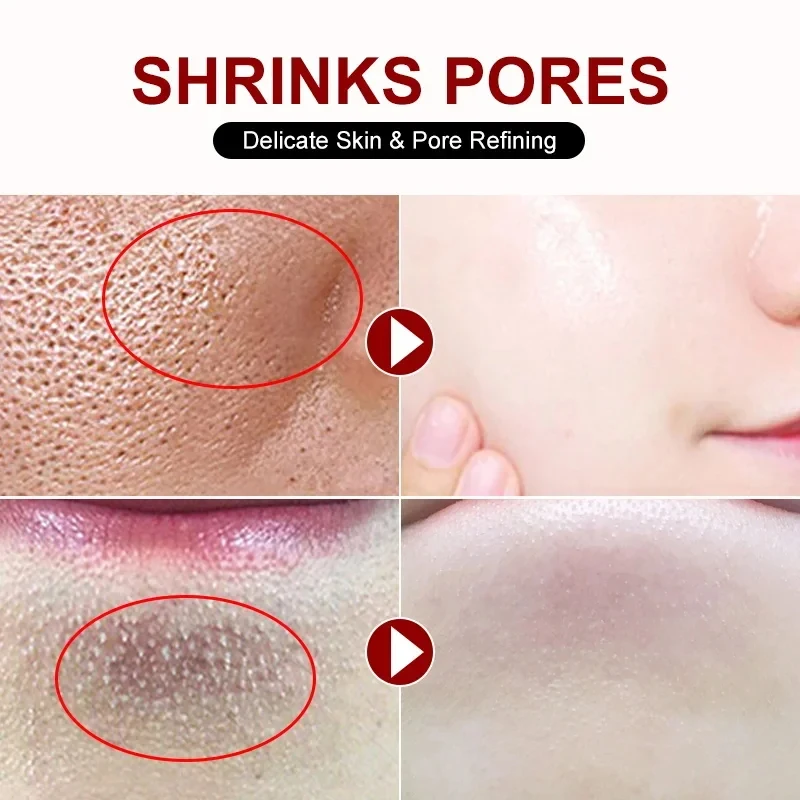 Ácido salicílico Poro Shrinking Creme, Eliminação Rápida, Poros Grandes, Remover Blackehead, Apertar o rosto, Produto de cuidados com a pele suave, 2024