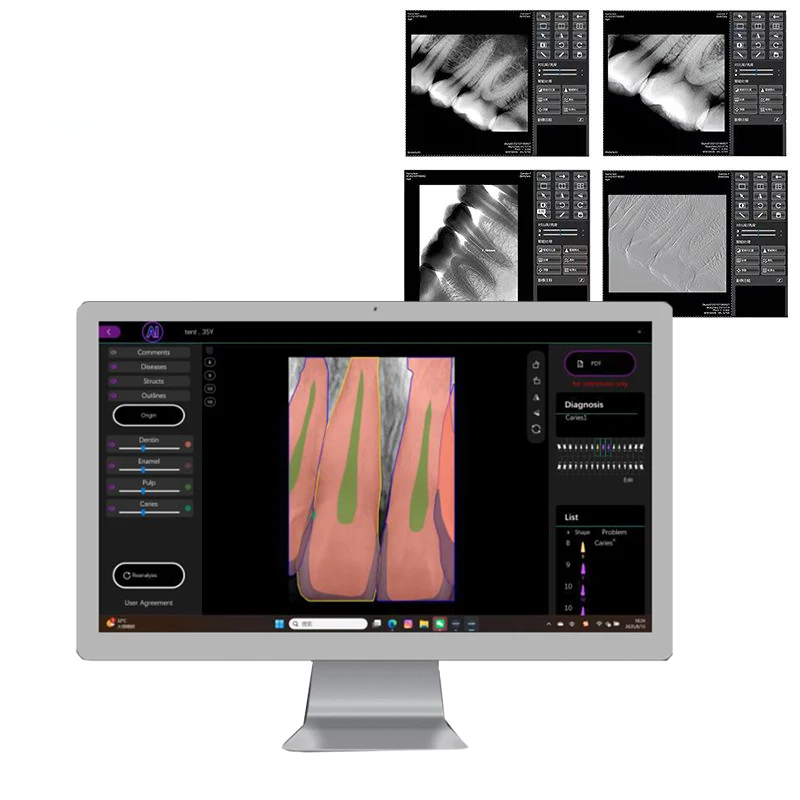 HD Image Dental Sensor Portable rayos x Digital RVG Intraoral Sensor Radiovisografo AI Diagnosis Dentistry Product Dentist Tools