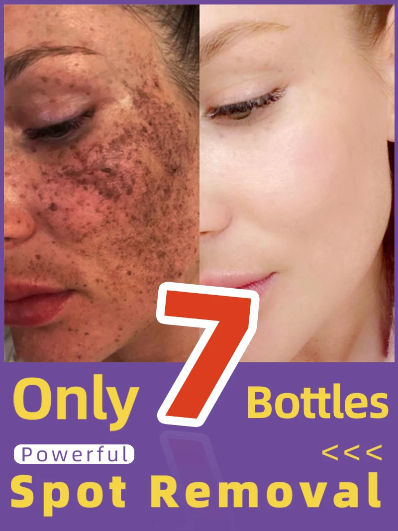 

Lightening Facial Freckles Melasma Dark Spots