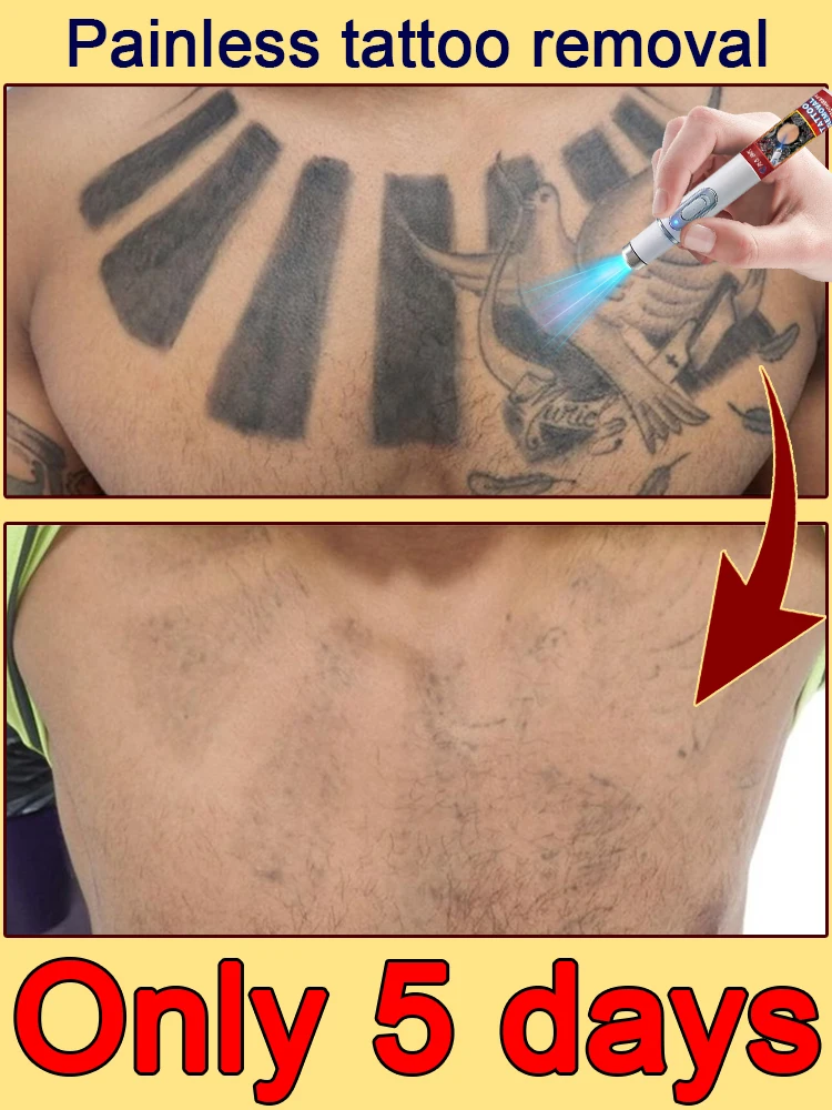 Rimozione del tatuaggio e rimozione del colore