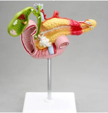 Diseased Pancreas, Duodenum And Spleen medical teaching model