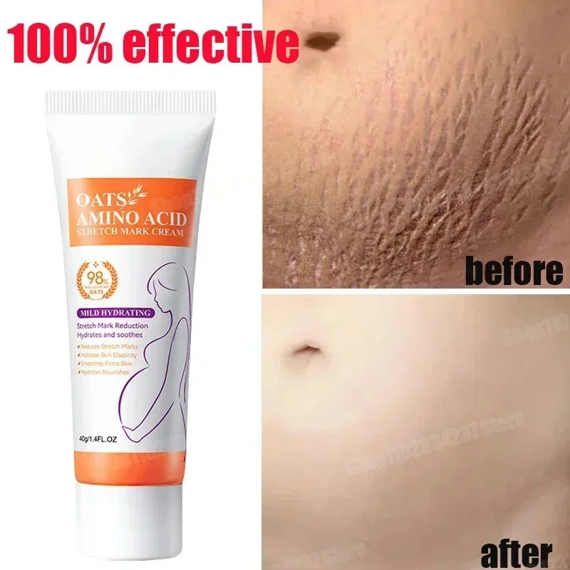 Scar Repair Cream Maternity Skin Repair Remove Pregnancy Surgical Scars Treatment Body Skin Care Cream