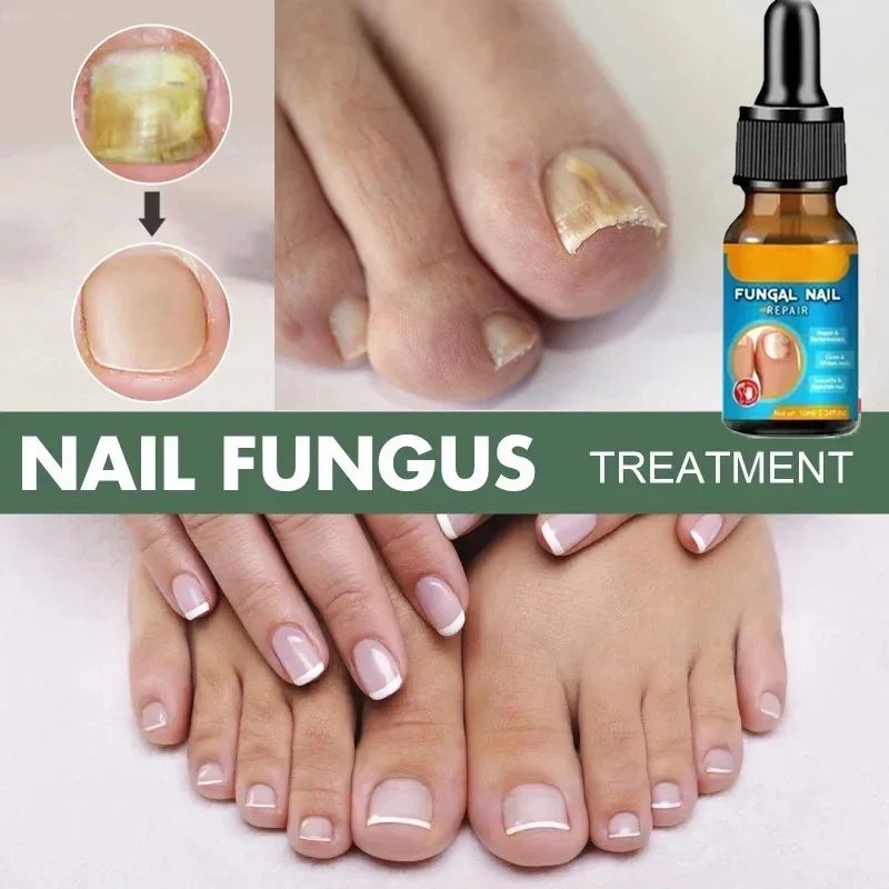 

Nail Fungal Treatment Essential Oil Foot Toe Nail Fungus Removal Serum 7 Days Repair Onychomycosi Anti Infection Care Products