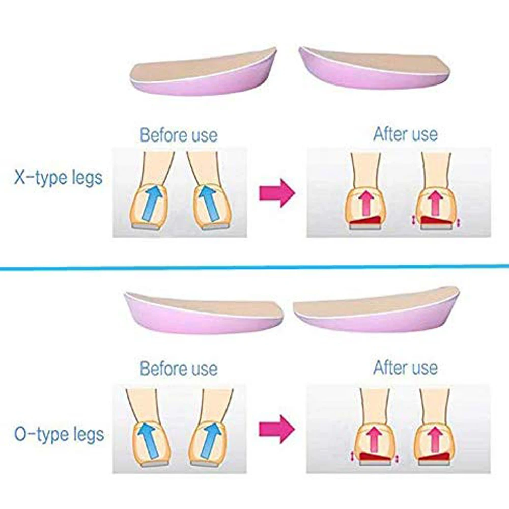 Tcare X/O Legs Orthopedic Shoes Insoles Silicone Gel Arch Support Pad for Women Flat Foot Orthotic Inserts Pain Relief High Heel